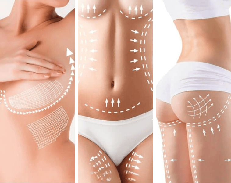 Mommy Makeover Areas